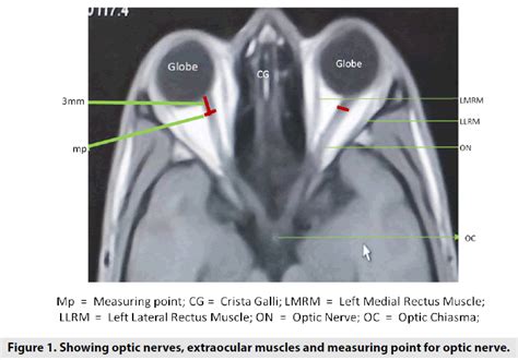 optic nerve thickness measurement mri|average optic nerve size.